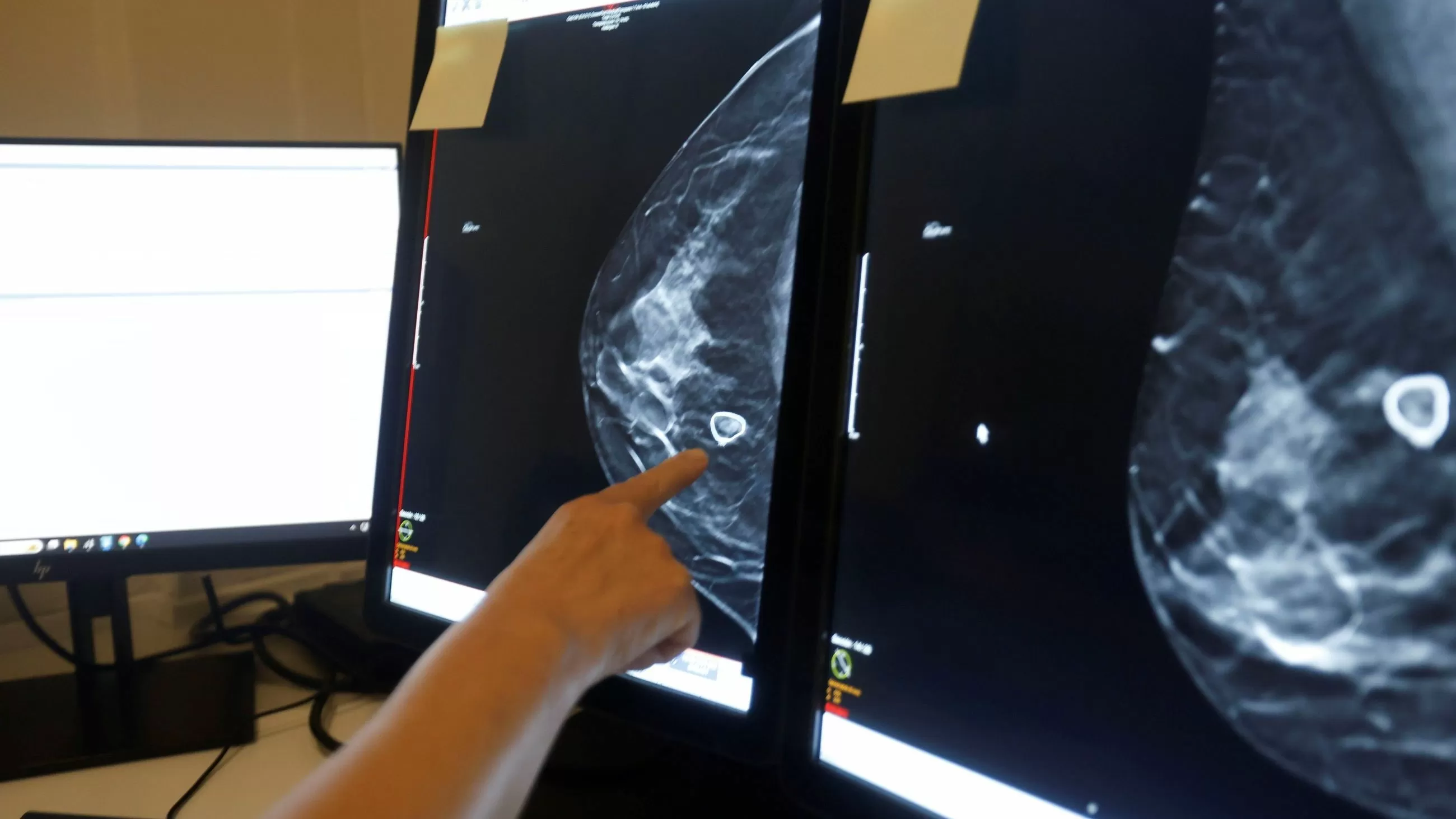 perspectiva frente al subtipo más agresivo de cáncer de mama gracias a una vacuna basada en neoantígenos
