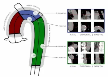 Desarrollan un sistema basado en IA que procesa tomografías del corazón