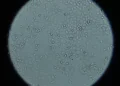 Científicos españoles identifican un persona de células para inmunoterapia que reduce el riesgo de recaídas en cáncer