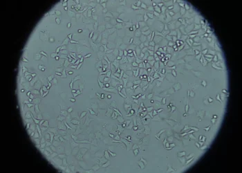 Científicos españoles identifican un persona de células para inmunoterapia que reduce el riesgo de recaídas en cáncer