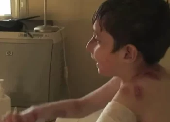 “Una cicatrización significativamente mejor, menos resentimiento y menos picazón en las heridas de pacientes con piel de mariposa”, gracias a una anuncio técnica de terapia génica