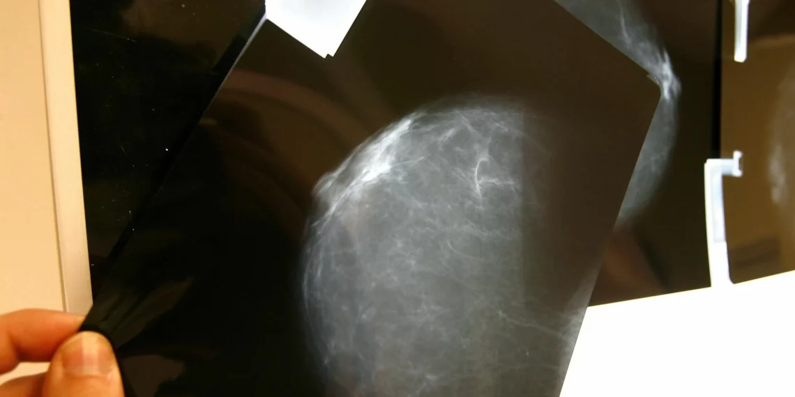 Los bacteria respiratorios pueden despertar y promover la metástasis pulmonar del cáncer de mama