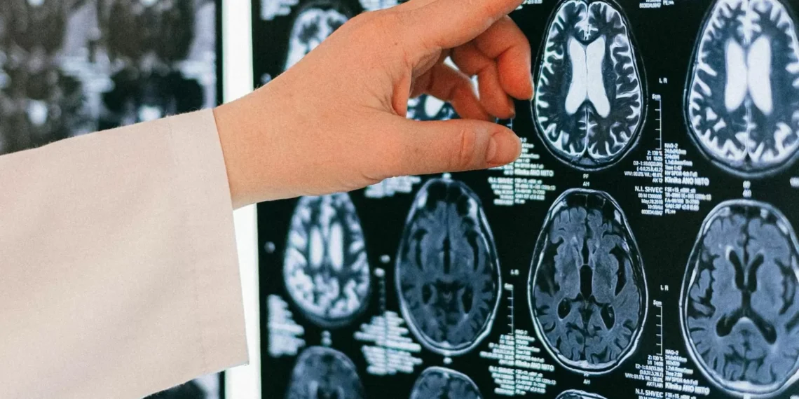 Un estudio revela que las células del envejecimiento cerebral pueden crecer el riesgo de Alzheimer y tumores cerebrales