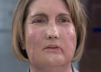 Realizado en España el primer trasplante de cara del espacio con donante por eutanasia